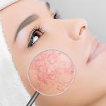 Pelle Couperose: Sintomi, Trattamenti, Cosmetici